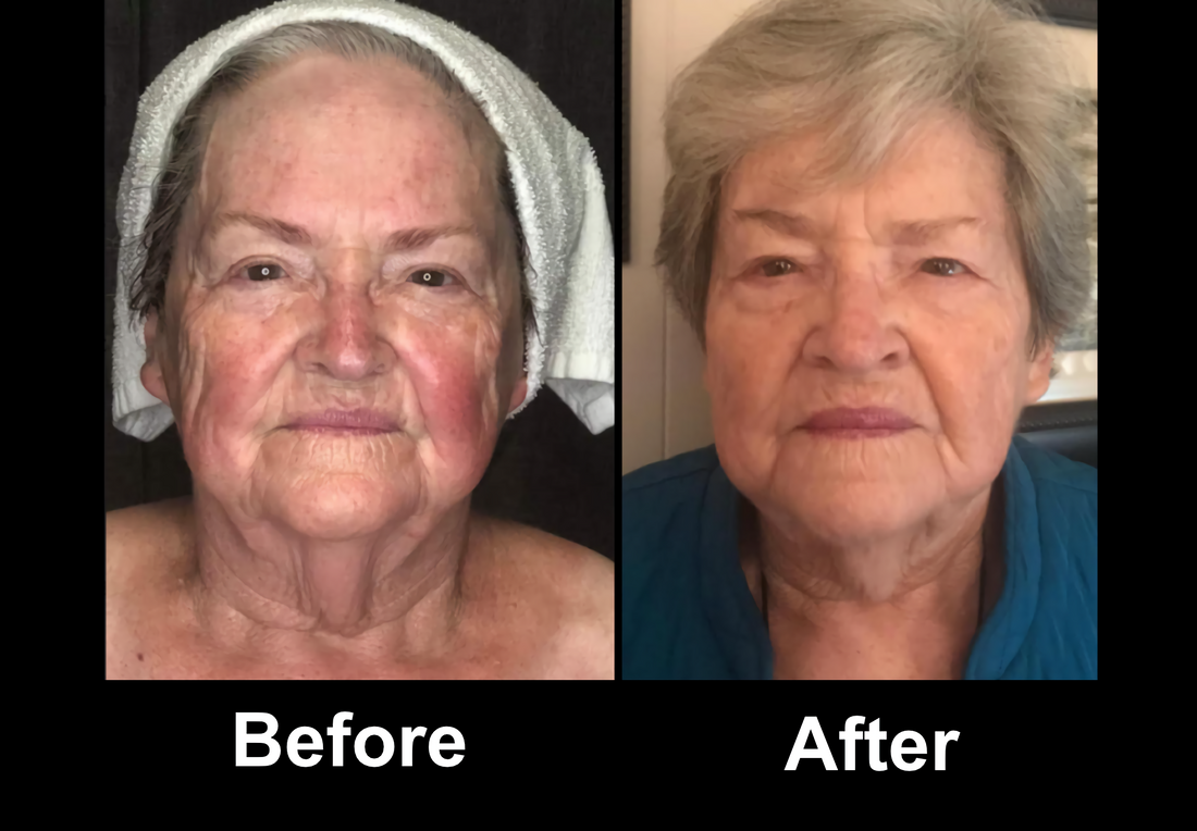 Blossom AWT B&A Aging Skin