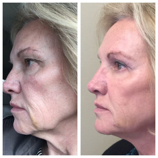 Novathreads B&A