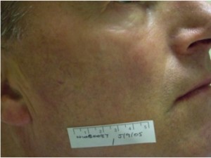 Facial Vessels After UltraPlus VPL Treatment