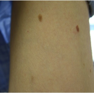 Freckle After UltraPlus VPL Treatment