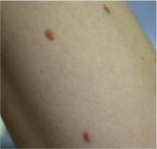 Freckle Before UltraPlus VPL Treatment