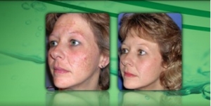 Before and After 6 DiamondTome Tx
