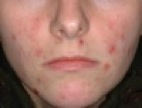 30 day acne clearing program