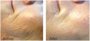 FCI Before, After, CIT, microneedling