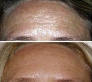 Fractional Collagen Induction B&A