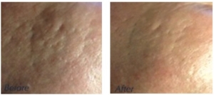 Before & After FCI, CIT, microneedling, acne scar