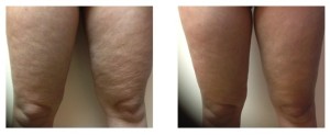 ThermiRF Cellulite