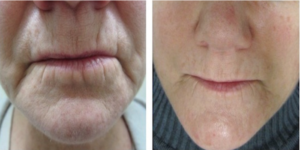 Procell B&A Wrinkles 02