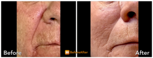 Procell B&A Wrinkles