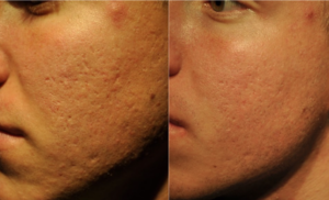 Procell Improves Acne Scar