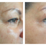 Procell Fine Lines Anti-Aging
