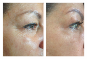 Procell Fine Lines Anti-Aging