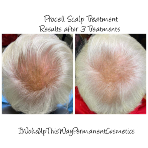Procell Hair Regrowth