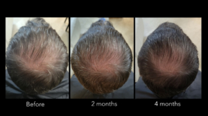 Blossom Wand Hydro-Screen Hair 4 Months